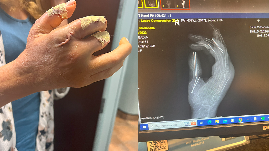 cirugpias en mano, por la condición de artritis